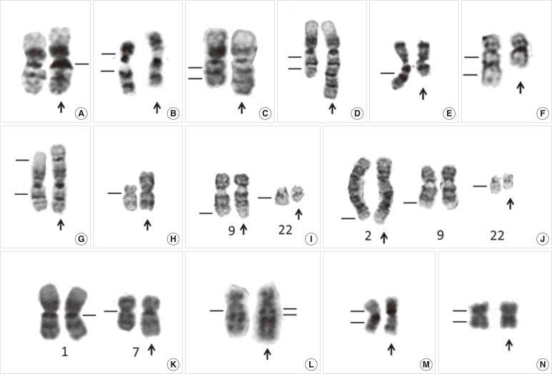 Fig 1. Examples of karyotypes of normal variants and chromosomal abnormalities in some leukemias. (Wan T S K, et al. 2014)