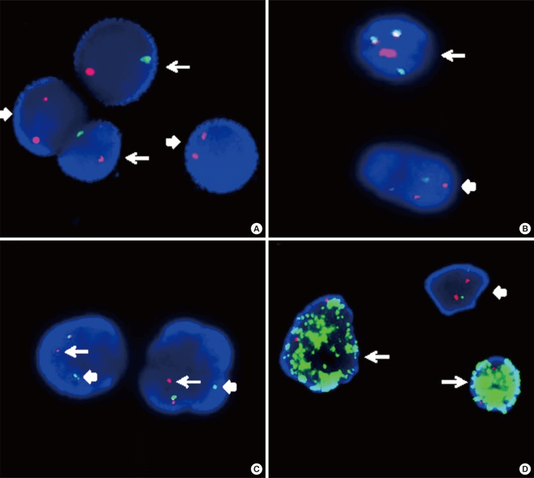 Fig 2. An example of interphase FISH applied to tumor cytogenetic analysis. (Wan T S K, et al. 2014)