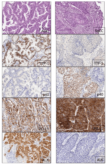 Fig 2. Representative examples of histology of lung adenocarcinoma (ADC) and squamous cell carcinoma (SqCC) histology and biomarker analysis using IHC. (Villalobos P, et al. 2017)