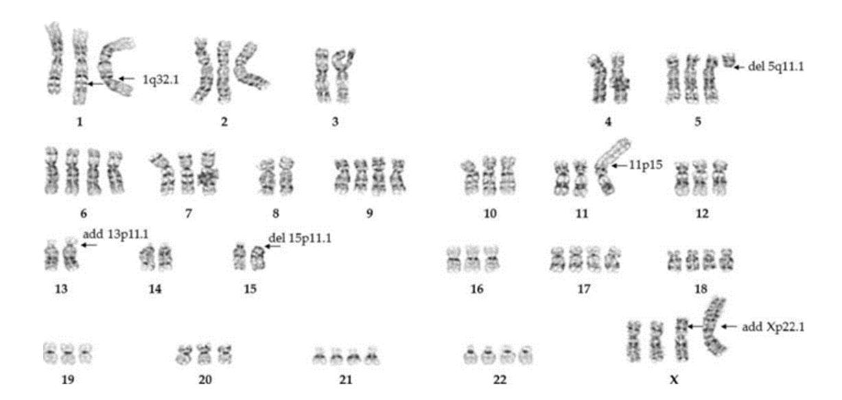 Figure 1. HEK293 Karyotype generated from HEK293 cultured cells. A representative G-band karyogram of a HEK-293 cell showing 71 chromosomes. Arrows indicate rearrangements, additions, and deletions.