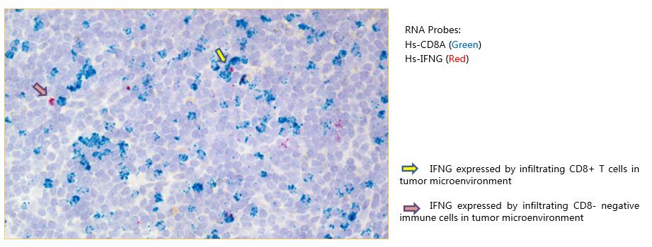 IFNg RNA Expression by Infiltrating CD8+ T Cells in Lung Cancer Microenvironment