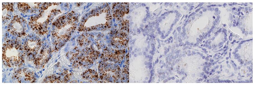 Evaluation of tissue PCA3 expression in prostate cancer by RNAscope.