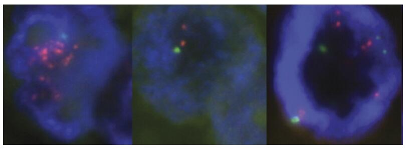 HER2 gene amplification testing by FISH for diagnosis of breast cancer.